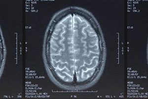 Снимок мозга