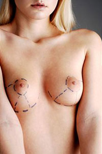 Женская грудь обведена фломастером для лечения
