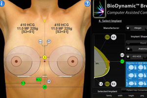 Компьютерное моделирование груди дает трехмерную модель молочных желез пациентки