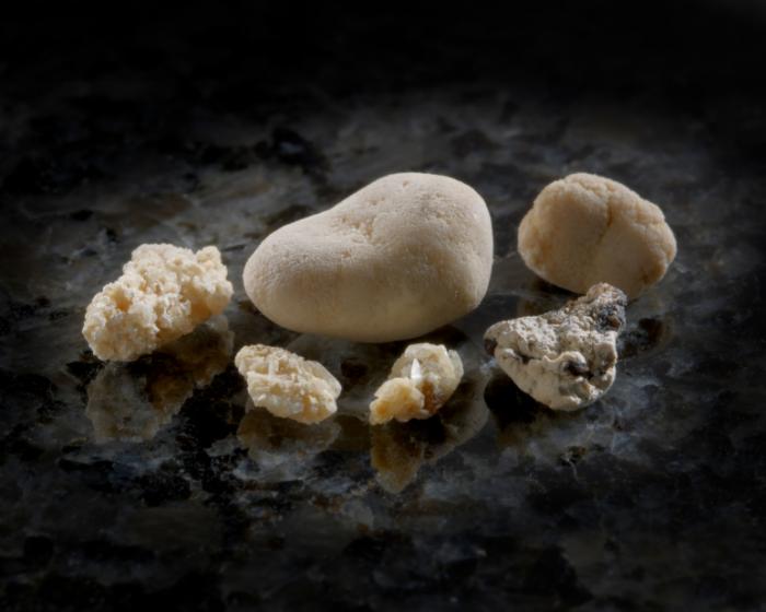 Камни в почках повышают риск инсульта