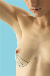 Подготовка к операции по увеличению груди