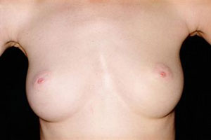 Фиброаденома груди