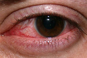 Кератит является редким глазным заболеванием