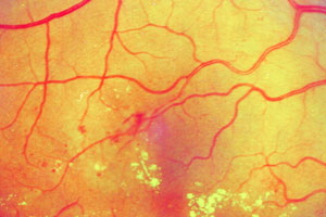 Диабетическя ретинопатия под микроскопом