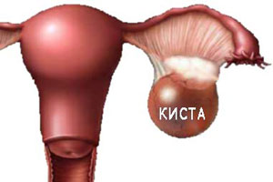 Чаще киста яичника появляется у женщин, страдающих ациклическими маточными кровотечениями, миомой или аднекситом