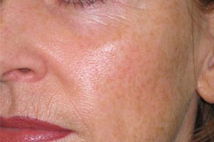 Фотостарение кожи лица