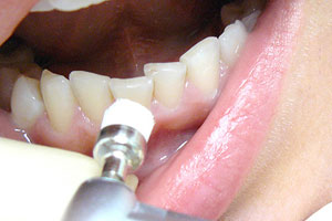 Обычное химическое отбеливание зубов