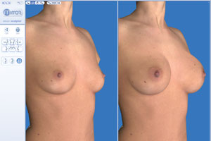 Компьютерное моделирование груди помогает избежать ошибки с выбором имплантанта