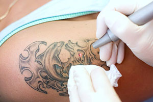 Удаление татуировок лазером болезненный процесс