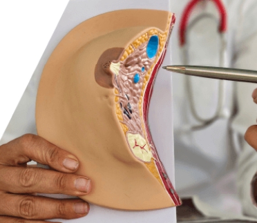 удаление фиброаденомы молочной железы