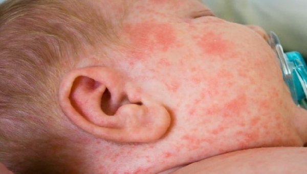 атопический дерматит у малыша.jpg